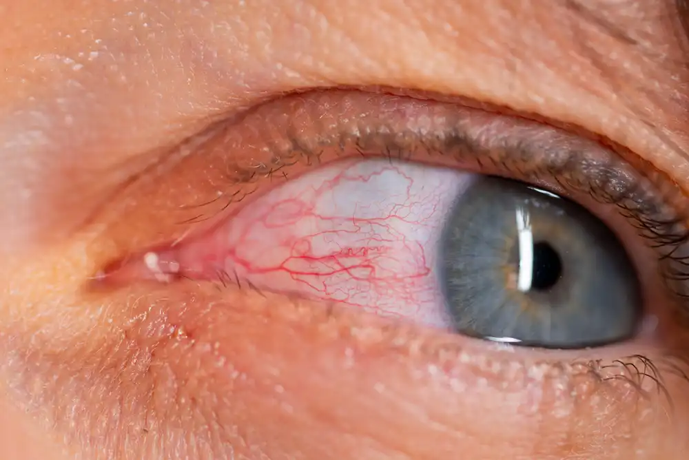 Why Dry Eyes Are A Common Side Effect