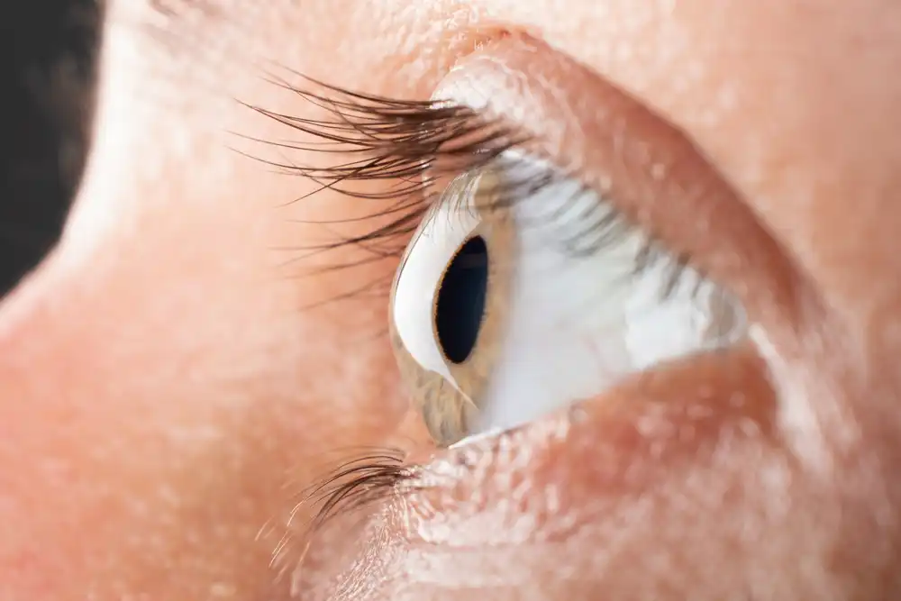 thin cornea